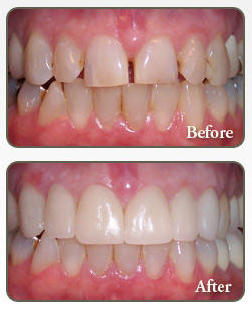 Veneers Dr. Toosharz Dental best dentist in delhi