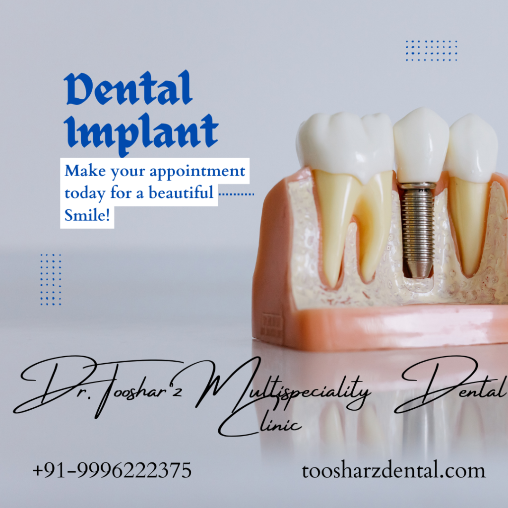 Elevating Smiles Unveiling the Excellence of Dental Implants in Lajpat Nagar, Defence Colony, and Greater Kailash, Delhi at Dr. Toosharz Dental Clinic