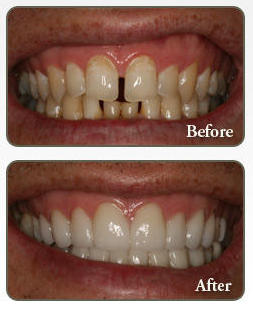 Invisalign before and after — Dr. Tooshar'z Multispeciality Dental Clinic, Lajpat Nagar Delhi