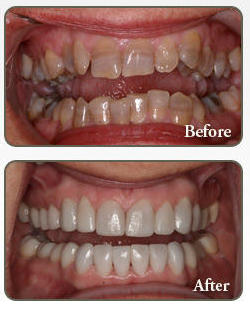 Complete smile makeover before and after — Dr. Tooshar'z Multispeciality Dental Clinic, Lajpat Nagar Delhi